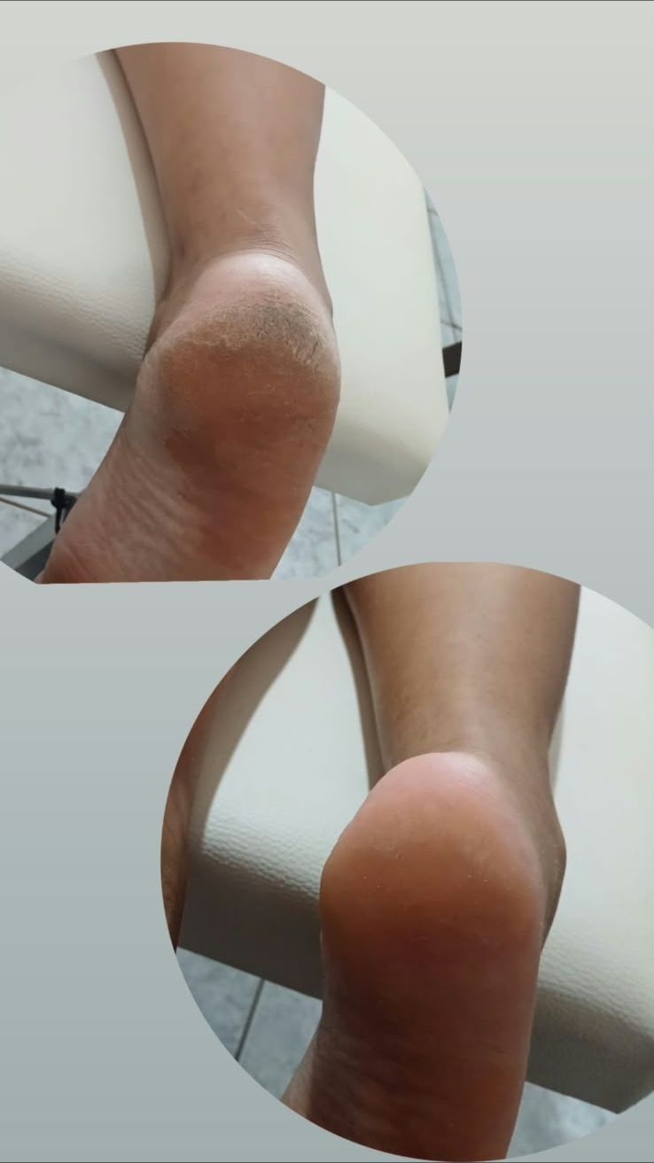 Plástica dos pés: calcanhar antes e depois, feita pela Priscila Calvo no Estilo Arte, em Araraquara