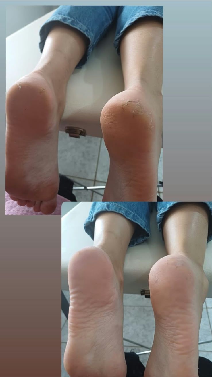 Plástica dos pés: solas antes e depois, feita pela Priscila Calvo no Estilo Arte, em Araraquara